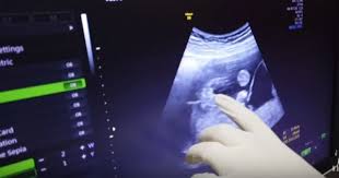 Download now hasil usg 2d 3d dan 4 dimensi perkembangan janin bayiku 24 minggu 2 hari naya 1. Syahnaz Hamil Anak Kembar Perempuan Dan Laki Laki Popmama Com