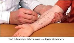 L'allergia alimentare è una forma specifica di avversione ad alimenti o a componenti alimentari (allergeni) che attiva il sistema immunitario o alcuni mediatori cellulari. Allergie Ed Intolleranze Alimentari Roma Gastroenterologo Dott Prof Antonio Iannetti