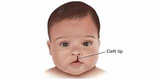 cleft lip and palate