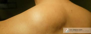 shoulder lipoma removal cost