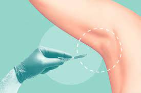 hyperhidrosis surgery for sweat gland