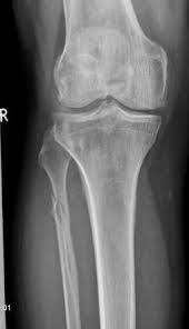 Description a combined injury pattern involving a fracture of the proximal/mid fibula plus a fracture or ligamentous injury of the medial ankle this injury disrupts the tibiofibular syndesmosis and creates an unstable ankle joint tip: Maisonneuve Fracture Radiology Reference Article Radiopaedia Org