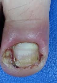 ingrown toenail infection curvecorrect