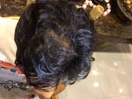 oily scalp