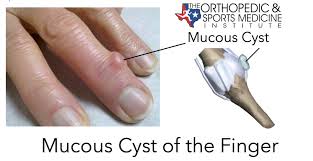 mucous cyst of the finger diagnosis and