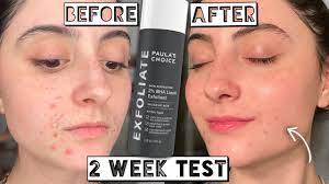 2 bha liquid exfoliant for acne