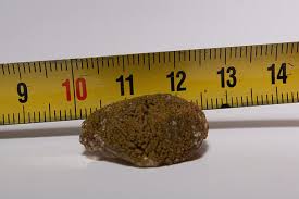 Gallstone Vs Kidney Stone Difference And Comparison Diffen