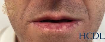 sun damaged lips actinic cheilitis