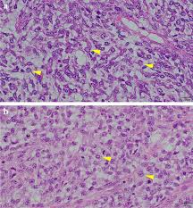 metastatic myxoid liposarcoma