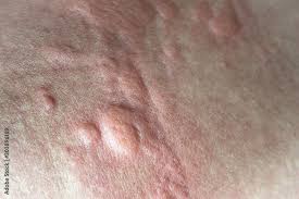urticaria on skin rashes of which