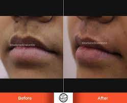 upper lip laser hair reduction treatment