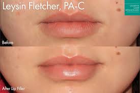 lip filler injections san go ca