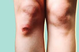 cellulitis complications how to treat