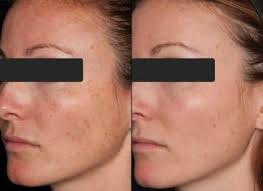 chemical ls aging acne wrinkles
