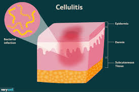 cellulitis what it looks like causes