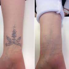 laser tattoo removal using picosure
