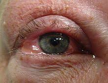 Close your eyes and imagine yourself. Conjunctivitis Wikipedia