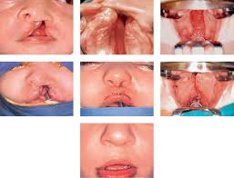 cranio growth in cleft lip and