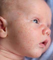 Baby Acne What Causes Them And How You Can Prevent