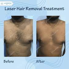 best laser hair removal in bangalore