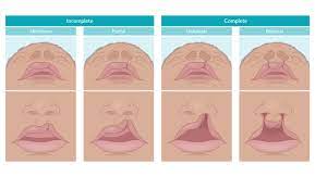 cleft lip and cleft palate knowledge