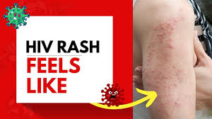 hiv rash feels like you