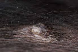 treat sebaceous cysts in dogs