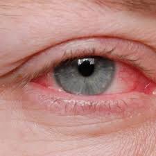 do i have pink eye 5 issues mistaken
