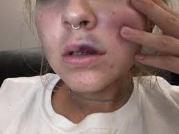 imate blue bruise after lip fillers