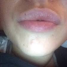 freckle mole removed on my lip photo