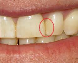 However, dentists that are not highly attuned to aesthetic issues will be uncomfortable doing that. How To Get Coffee Stains Out Between Teeth