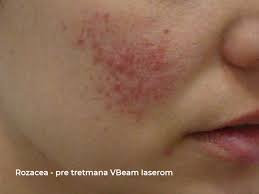 rosacea vbeam laser treatment dermatim