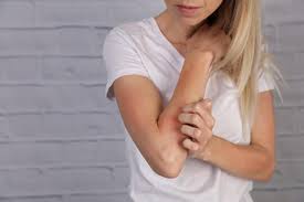 stop hiding eczema is preventable and
