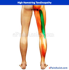Press your heels into the ground and squeeze your glutes, raising your hips towards the ceiling. High Hamstring Tendinopathy Treatment Exercises Causes