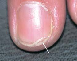 diseases and abnormalities of nails