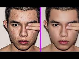 remove pimples blemishes acne easily