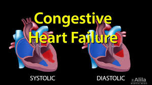 Congestive Heart Failure Left Sided Vs Right Sided Systolic Vs Diastolic Animation