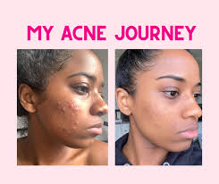 my acne journey how tretinoin