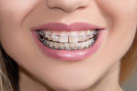 Depending on the cause it can be called: White Spots On Teeth After Braces Teethwalls