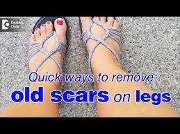 how to remove old scars on legs fast