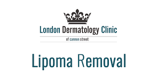 lipoma removal same day 299 london