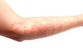 hives urticaria causes symptoms