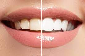 6 natural ways to whiten your teeth