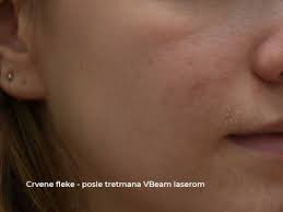 acne scar treatment laser