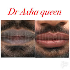 dark lip treatment in chennai anna