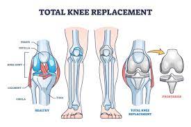 total knee replacement what are the