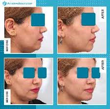 How much is chin lipo uk. Double Chin Surgery In Iran Double Chin Removal Ariamedtour