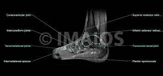 An mri will confirm the diagnosis and allow differentiation of other causes of masses in the foot, such as lipomas, ganglions, neuromas, herniations of the plantar fasica, and. Anatomy Of The Foot And Ankle Mri