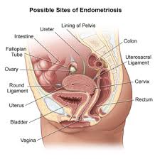 Symptoms may include abdominal pain, heavy periods, and. Endometriosis Johns Hopkins Medicine