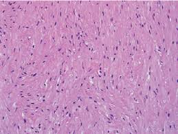 smooth muscle tumor with low